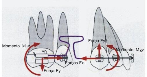 2) Altura óssea alveolar diminuída, a seta indica a localização mais apical do cr. 3)