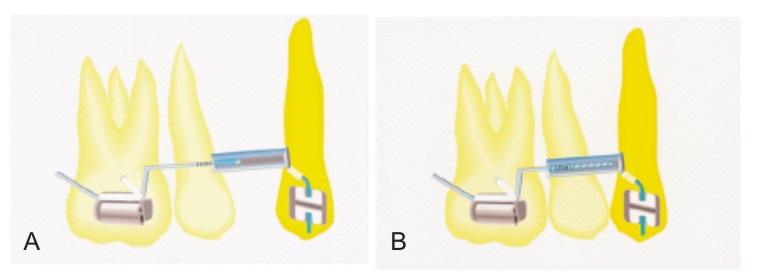 35 acordo com o autor, esta alça é capaz de produzir movimento de corpo por durante 4,0mm de desativação e com controle radicular.