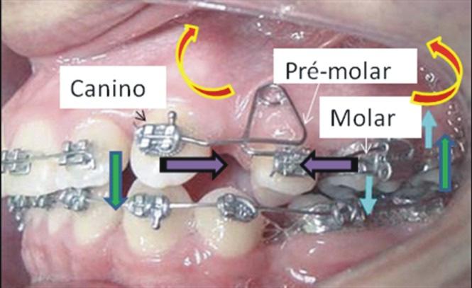 63 Figura 32 - Caso clínico exibindo alça delta do Grupo G 1 com o objetivo de retração do canino Nota: As flechas azuis denotam o binário que ocorre no tubo de encaixe após inserção da alça em sua