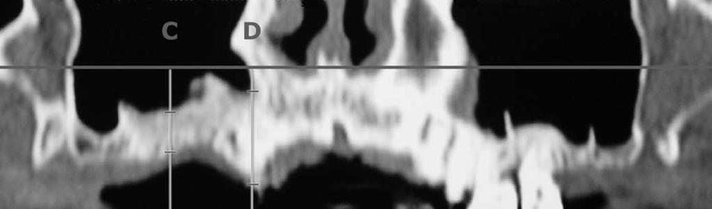 Análise por tomografia computadorizada do enxerto autógeno na cirurgia de sinus lift pneumatização do seio maxilar e diagnóstico de possíveis doenças sinusais.