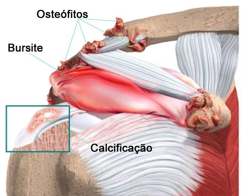 Na fase calcária, os cristais de cálcio são depositados no tendão. Então eles começam a desaparecer. O corpo simplesmente reabsorve os depósitos de cálcio. Ironicamente, é nessa fase que a dor ocorre.