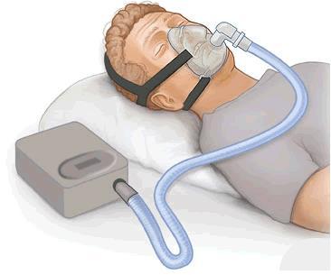 Simões (2018) para Síndrome da Apneia do Sono é o "CPAP, Suporte Ventilatório com Pressão Positiva Contínua" em vias aéreas.