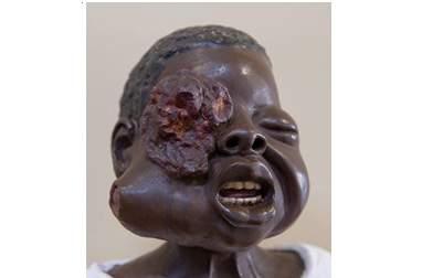 Mostra uma cabeça de criança de raça negra, aproximadamente com 3 anos de idade, com um tumor do globo ocular direito e órbita, e possível invasão da face homolateral, por metástase.