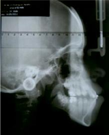 Fotografias intrabucais: (c) lateral direita, (d) frontal, (e) lateral esquerda. Observa-se que a paciente encontra-se em uso de aparelho fixo.
