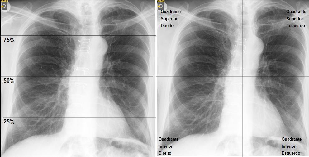 Métodos 39 Figura 3- Avaliação do grau de complicação pulmonar por meio da divisão da imagem da radiografia de tórax em quadrantes.