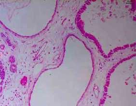 Proliferação epitelial com projeções digitiformes para o interior do lúmen acinar (seta). B) Hiperplasia prostática epitelial cística. Proliferação epitelial com ácinos dilatados e irregulares (seta).