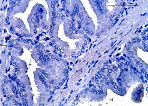 Células epiteliais (seta cheia) com escore quatro e estromais (seta vazada) com escore três para número de células imonoimunomarcadas.