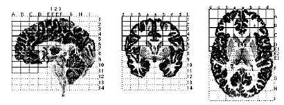 Divisão em lobos cerebrais, núcleos subcorticais, cerebelo e ventrículos laterais e representação em BrainImage mostrando aumento da quantidade da