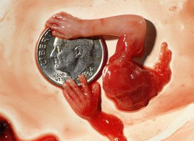 Aborto de bebê