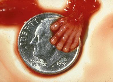 Aborto de bebê