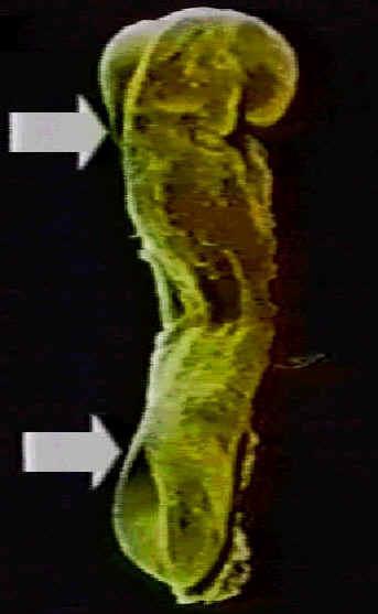Defeito dos tubos neurais Patogênese A anencefalia corresponde a um defeito de fechamento da porção anterior do tubo neural e da espinha bífida na