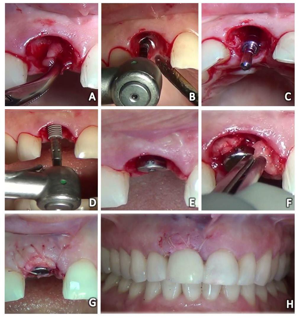 Figura 2 - A: Curetagem do tecido granulomatoso; B Perfuração com a broca lança; C: Pino Guia demonstrando a adequada inclinação do implante; D: Instalação do implante; E: Cicatrizador; H: