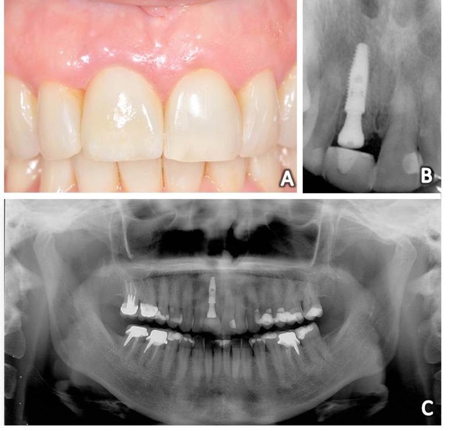 resina fotopolimerizavel nos dentes 12 e 21 (Figura 2H). A sutura procedeu-se com fio absorvível de com Poliglactina 5.0 (Vicryl ).