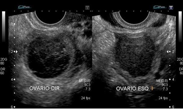 Ovário esquerdo de aspecto habitual, exibindo pequena formação cística simples que corresponde a folículo de natureza funcional Figura 2.