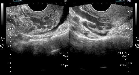 55 Apresentação ecográfica da endometriose Figura 5.