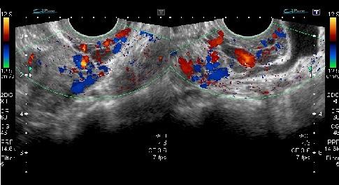 Nota: Ultrassonografia transvaginal para pesquisa de endometriose evidenciou estruturas tubulares, serpiginosas, localizadas na