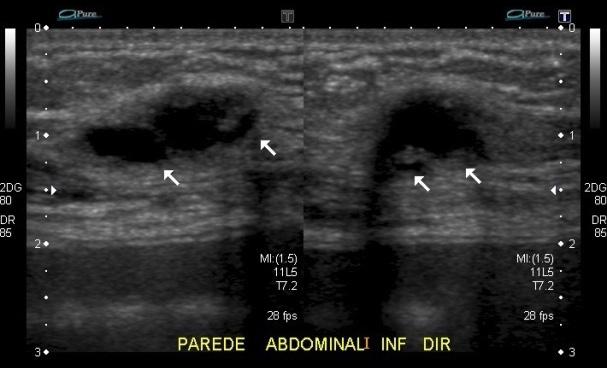 Exame ultrassonográfico da parede abdominal mostrou nódulo sólido hipoecoico, de contornos lobulados e limites definidos, em