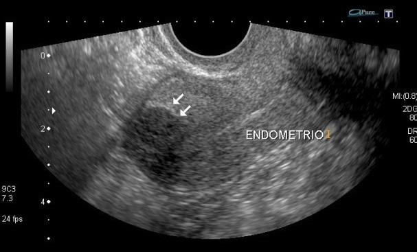 56 Apresentação ecográfica da endometriose Figura 10. Endometriose uterina.