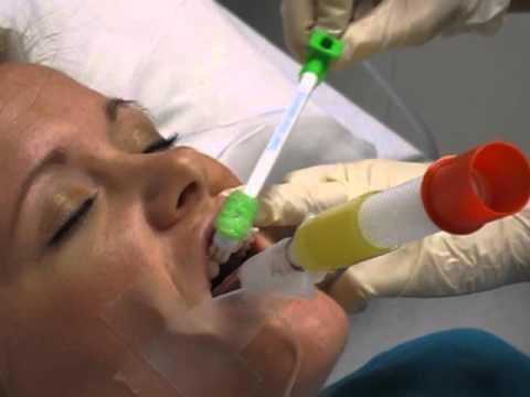Higiene oral com clorexidina Efeito pronunciado na prevenção em pacientes de cirurgia cardíaca Também reduz pneumonia