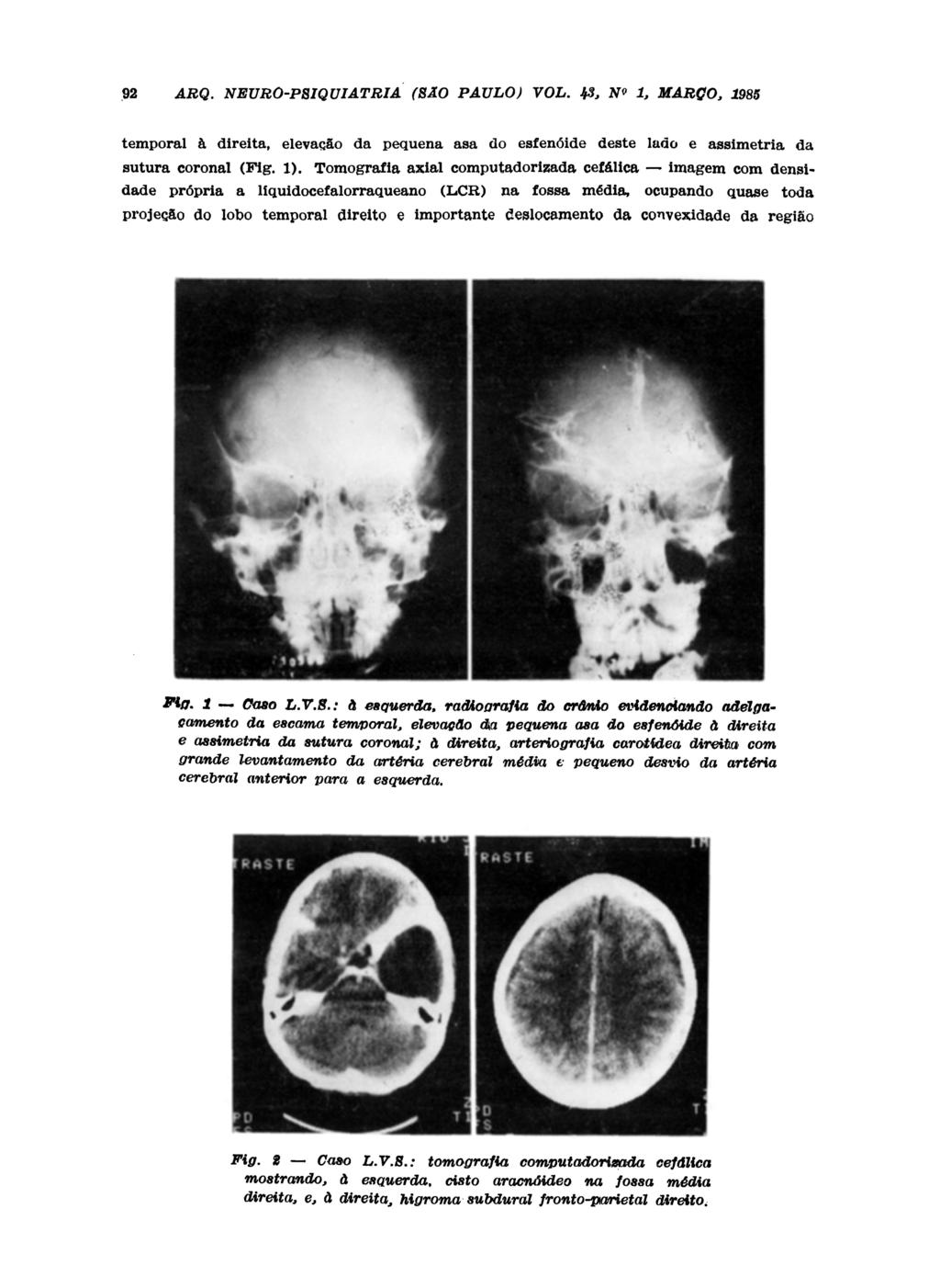 temporal à direita, elevação da p e q u e n a a s a do e s f e n ó i d e deste lado e a s s i m e t r i a da s u t u r a coronal ( F i g. 1).