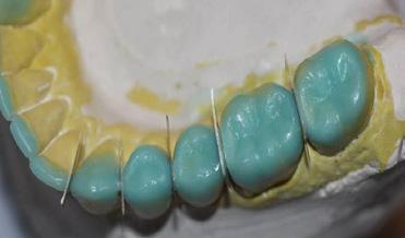 aço cortando a cera ate o ponto de contato dentário