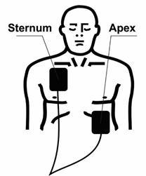 Sternum-Apex OU Posterior-Apex Crianças com espaçamento do tórax menor que 4 cm 5 Quando avisado, plugue o conector ao DEA Amós Trainer CR.
