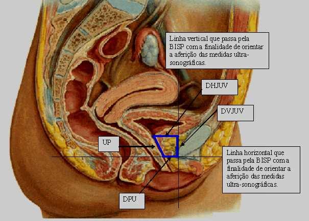 27 Deslocamento ou Mobilidade vertical da junção uretrovesical - Distância vertical, em milímetros, percorrida pela JUV durante o esforço (manobra de Valsalva).