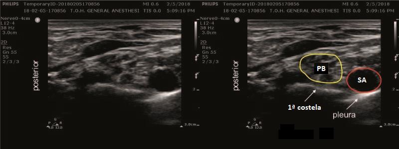 O processo transverso de C7 é identificado por um pequeno tubérculo anterior no ultrassom, e pode ser comparado à C6 deslizando-se o transdutor entre as vértebras adjacentes (Figure 8).