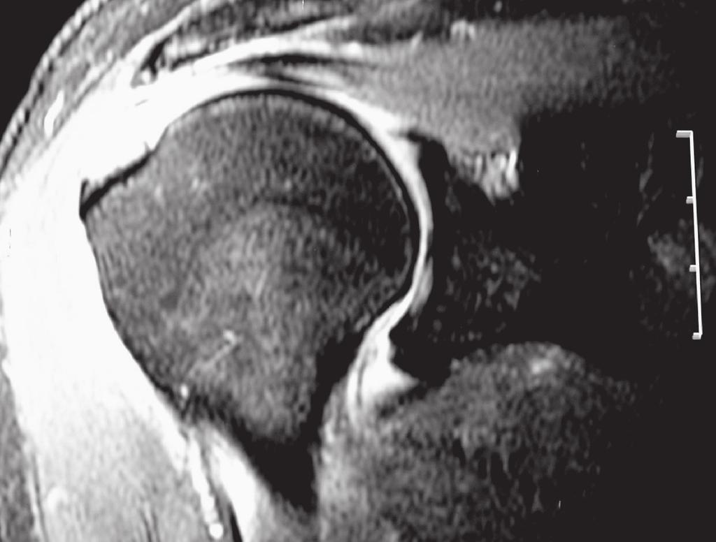 Avaliação funcional do reparo artroscópico das lesões completas do manguito rotador associado a acromioplastia 507 Figura 1 Imagem coronal T2 de ressonância magnética do ombro mostrando lesão