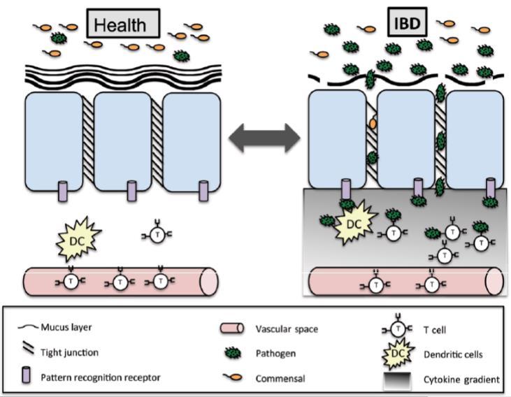 Figura 2 Os mecanismos patofisiológicos da IBD. A barreira mucosa de um individuo saudável mantem o conteúdo do lúmen separado do sistema imune.