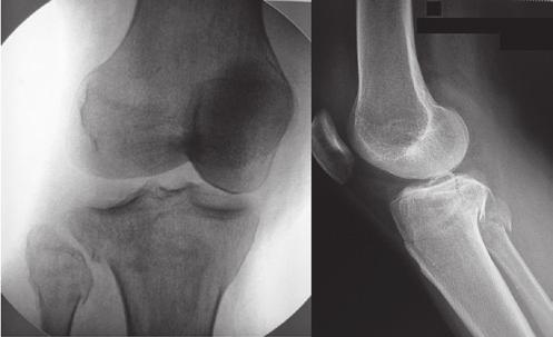 Serviço de Ortopedia e Traumatologia São Paulo Brasil 3 Ao exame físico, apresentava dor, edema e limitação do arco de movimento do joelho, sem alterações neurovasculares.