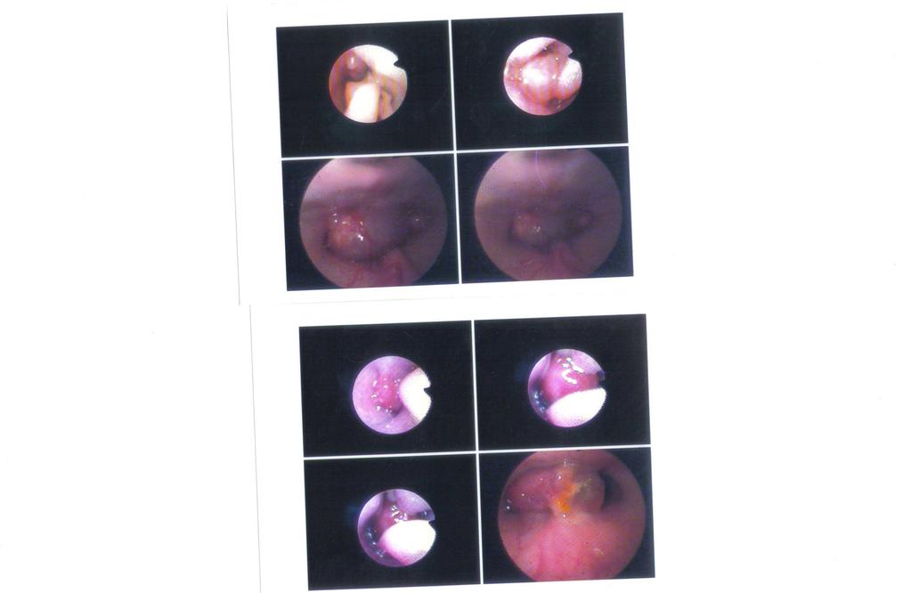 Figura 19 - Imagem digitalizada de cavidade nasal direita durante a rinoscopia anterior de cão, Golden Retriver, macho, dez anos de idade com diagnóstico conclusivo de carcinoma: (a) proliferação