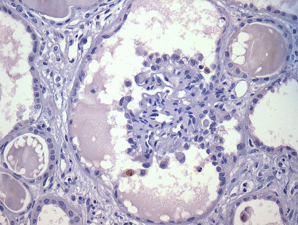 46 FIGURA 16- Glomérulo de GESF COL positivo para Ki-67 em podócitos da lesão (imunoperoxidase anti-ki-67; 400x) 4.2.