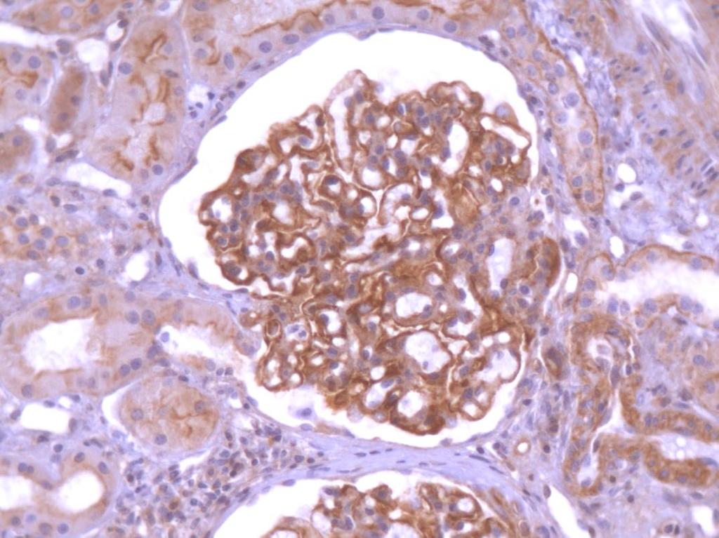 anti-α-actinina-4; 400x) FIGURA 18- Glomérulo de GESF TIP