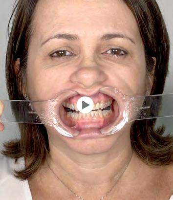 REABILITAÇÃO ESTÉTICA ANTERIOR Já no protocolo de vídeo com smartphones ou