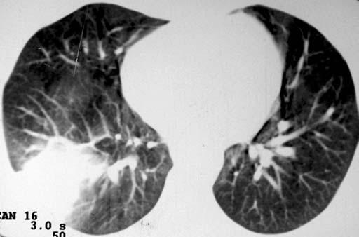 TCAR nas complicações pulmonares pós-transplante de medula óssea FASE NEUTROPÊNICA Na fase imediatamente após o transplante há um período de neutropenia profunda que dura de duas a três semanas.