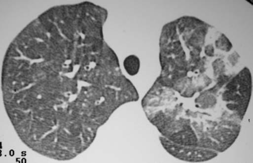 TCAR nas complicações pulmonares pós-transplante de medula óssea Figura 6.