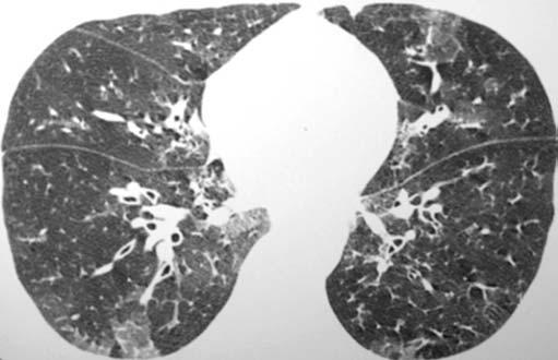 TCAR nas complicações pulmonares pós-transplante de medula óssea causa parece estar relacionada à toxicidade durante o preparo pré-transplante (2).