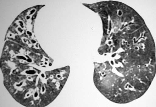 Observa-se deterioração gradual das provas de função pulmonar e o diagnóstico é baseado na clínica e nestes exames.