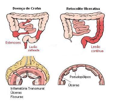 Fisiopatologia e Sintomatologia Conforme a doença progride, a parede intestinal torna-se cada vez mais espessada, com luz estreita e a membrana mucosa com aspecto emborrachada.