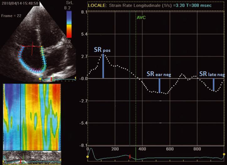 3.2. - Curvas de Strain Rate Auricular Independentemente da primeira frame de referência, a curva de SR será trifásica: Durante o enchimento auricular identifica-se