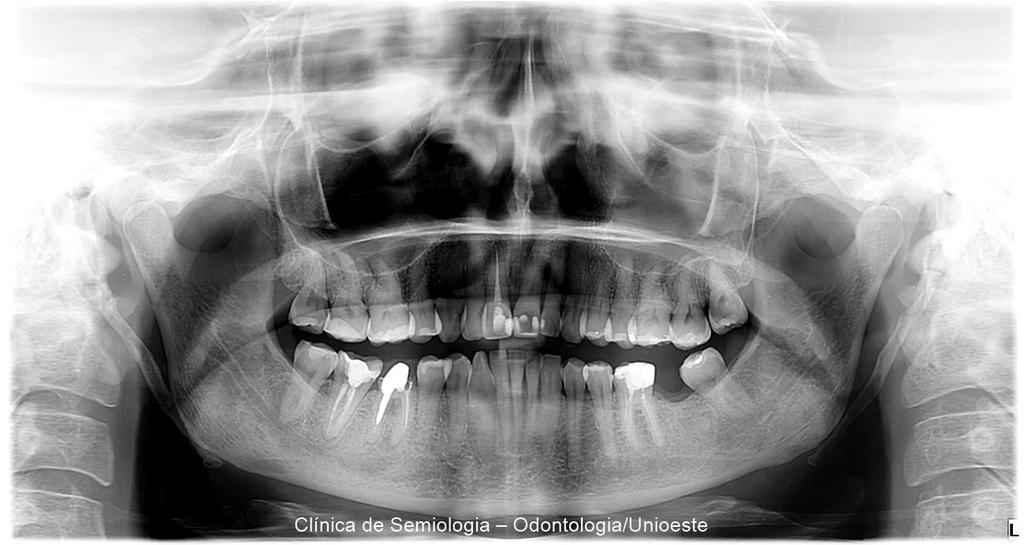 Exame radiográfico (panorâmica): Dentes 18, 15, 12, 23, 25, 28, 35, 34, 33, 32, 31, 41, 42, 42, 44, 45, 48 hígidos sem necessidade de intervenção.