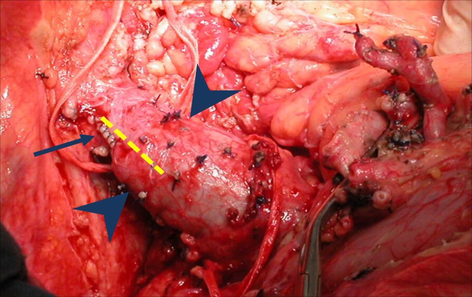 41 Figura 8 Foto ilustrativa da cavoplastia longitudinal. O óstio da veia hepática direita (seta) é ampliado (linha tracejada amarela) ao longo do eixo da veia cava inferior (entre cabeças de seta).