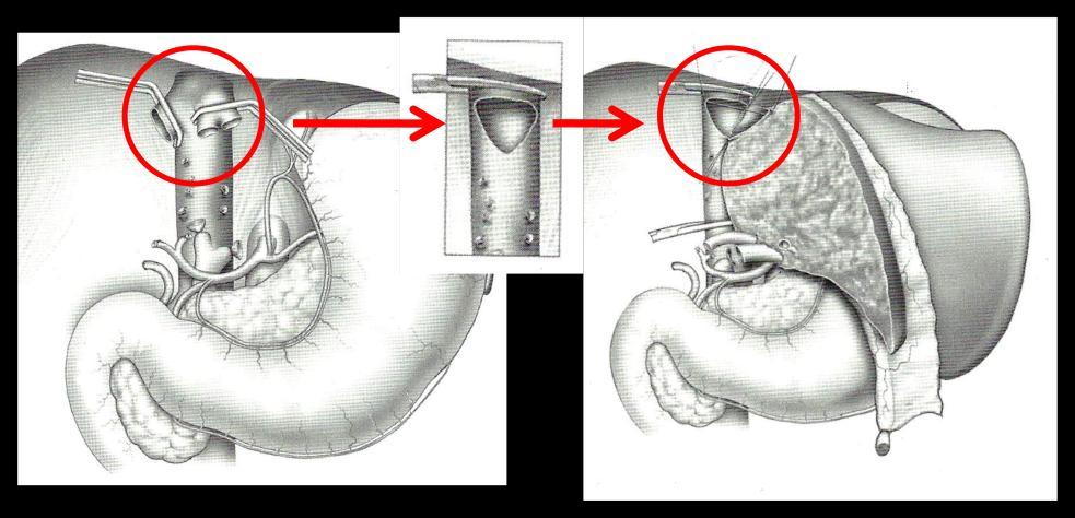 84 No caso de enxertos com baixo valor de GRWR, ou seja, pequenos para o receptor, pode ocorrer torção da veia hepática, devido à posição pendente do enxerto no espaço morto deixado na cavidade