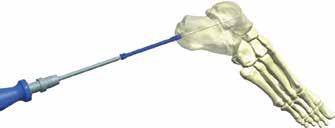 9 Selecionar um parafuso de compressão no mínimo 2 mm menor que a medida obtida do túnel ósseo, para permitir a compressão do foco da fratura e alojar a rosca proximal na cortical óssea.