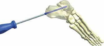 A medida de comprimento deve ser obtida da cabeça ao final do parafuso. É mandatório que a rosca distal do parafuso não fique ao nível do foco de fratura, pois assim não ocorrerá a auto-compressão.