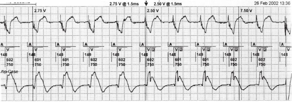 Figura 1 - Obtidas durante uma avaliação do limiar de captura. As mudanças associadas com o QRS no ECG de superfície são sutis, quando há perda de captura do VE (traçado superior).