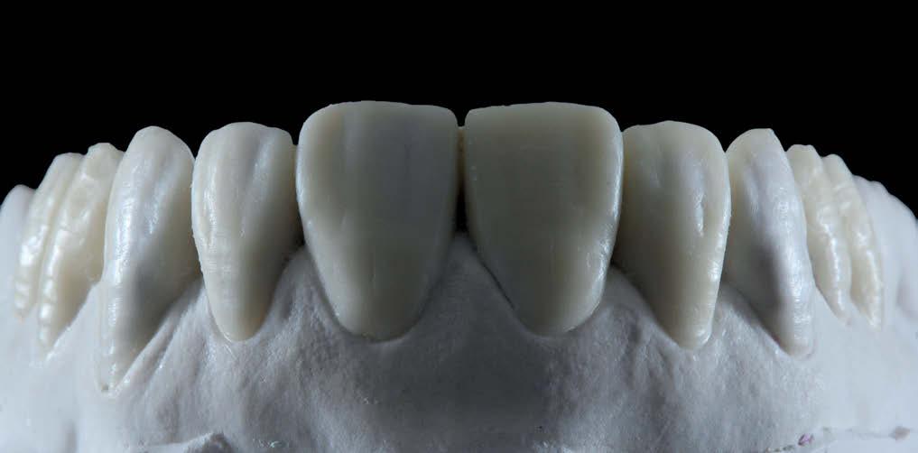 Restaurações cerâmicas em dentes anteriores Figura 9