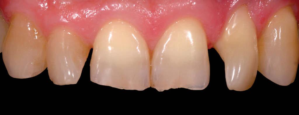 Calixto R, Massing N Figura 11 - Note que o caso apresenta um grande desalinhamento dentário,