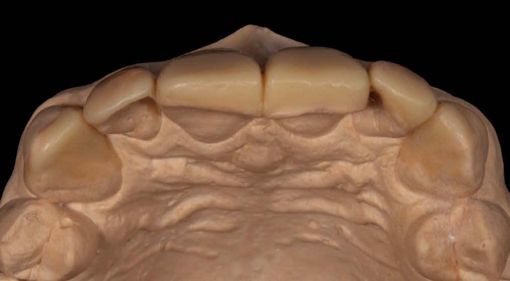 Clinically based diagnostic wax-up for optimal esthetics: the diagnostic mock-up.